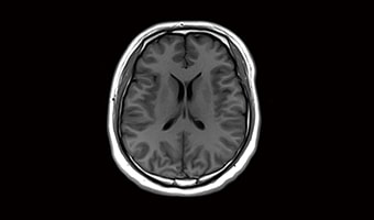 i_Vision 1.5T — Brain T1 FLAIR