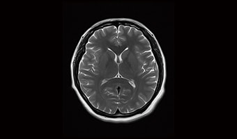 i_Vision 1.5T — Brain T2