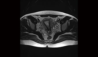 i_Vision 1.5T — Pelvic Axial T2