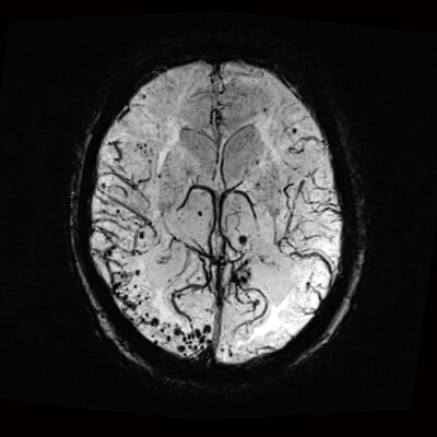 MRI Görüntüleme — Nöroloji & Beyin
